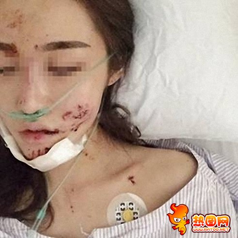 知名网红被毁容 知名网红惨遭毁容之祸社会gif搞笑图片