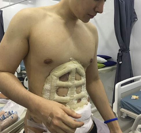 腹肌整形手术的图片社会gif搞笑图片