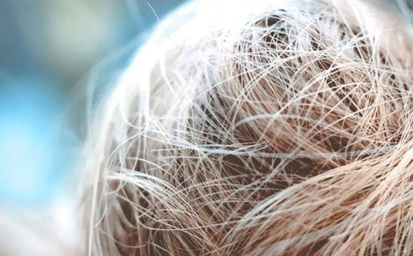 白头发吃叶酸会变黑吗?一文解说白发的五个原因