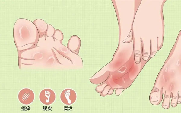 脚气最怕三个土办法，如何预防脚气传染