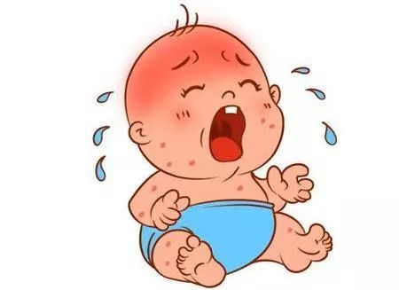 怎样缓解湿疹？