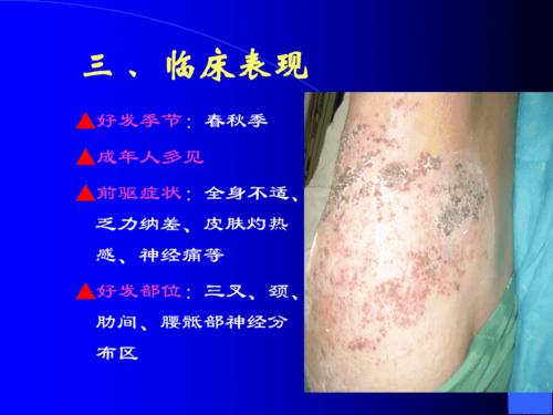 带状疱疹的发病原因和治疗方法