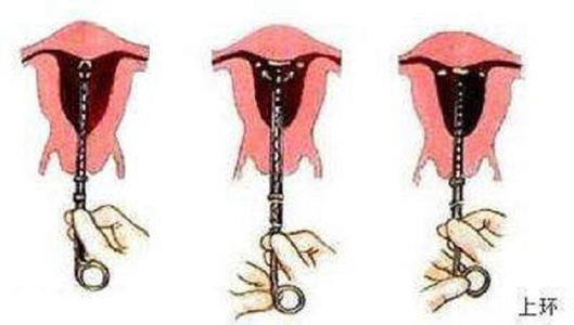 上环不仅仅出血这么简单