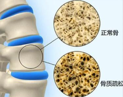 骨质疏松小知识
