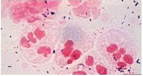 淋病有哪些治疗方式