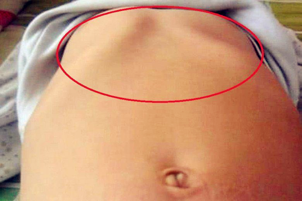 孩子鸡胸的图片，再补救也难回当初！