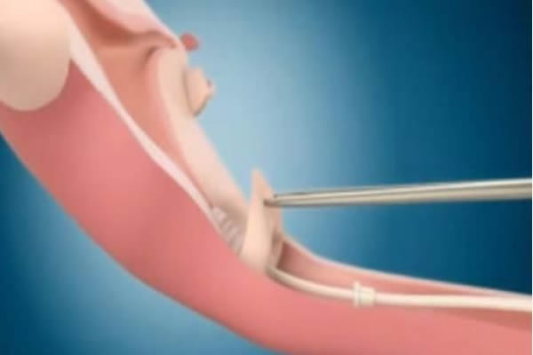 为什么不建议女人上环是有原因的，上环后的副作用有必要了解一下