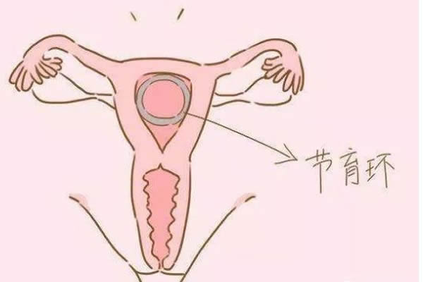 「节育环小知识」o型节育环图片，带你全面了解o型节育环