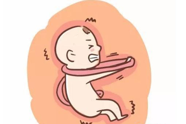 专家带你了解脐带绕颈调整姿势图片