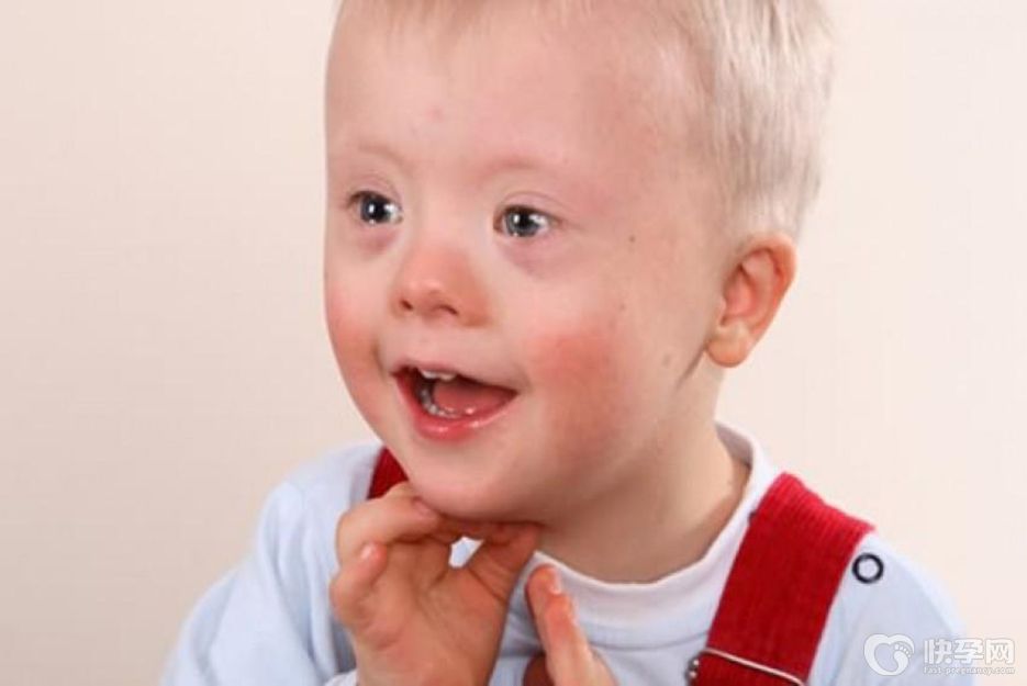 唐氏综合征和父亲年龄有关吗？ 父亲年龄不容忽视