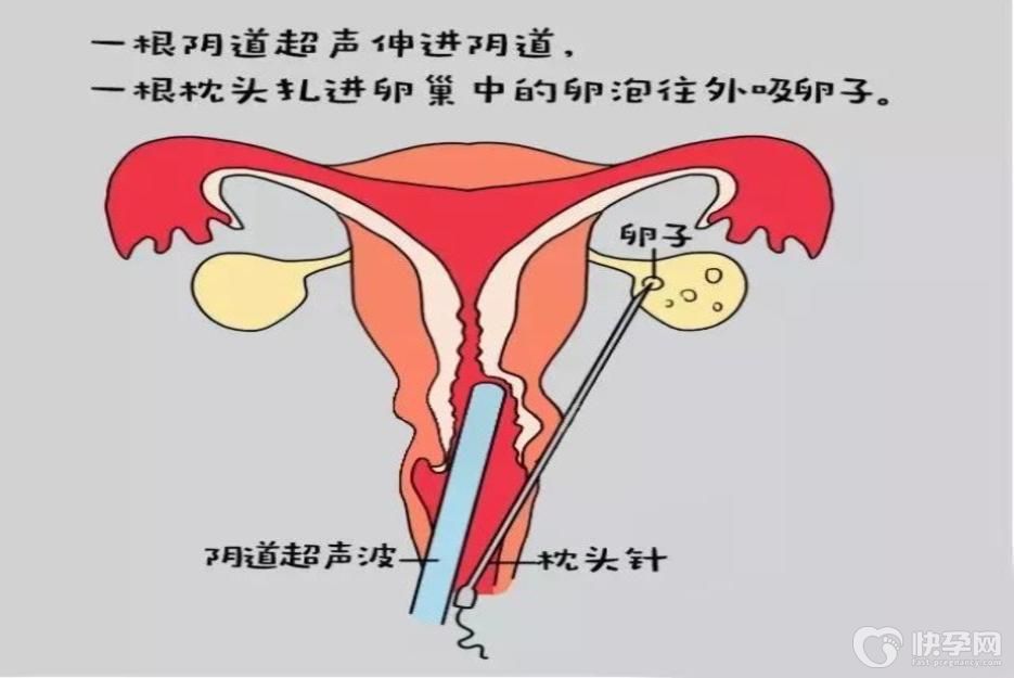 试管婴儿手术全过程，了解透彻才不会心生恐惧