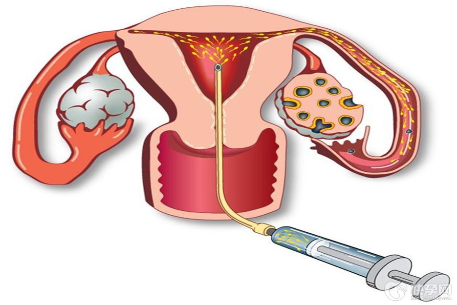 人工授精和试管婴儿的区别？老大哥人工授精带你了解试管婴儿