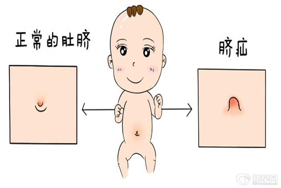 育儿论谈：为什么医生不让用脐疝带？一文解说脐疝来历
