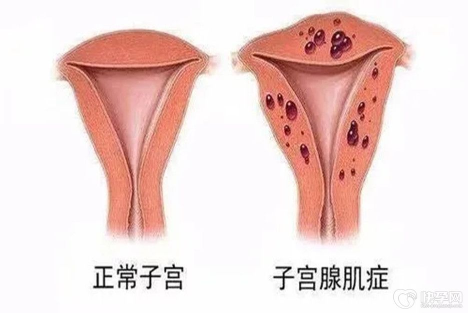 通过子宫腺肌病不能忍,拖延不治易致不孕-知因知果才能预防到位