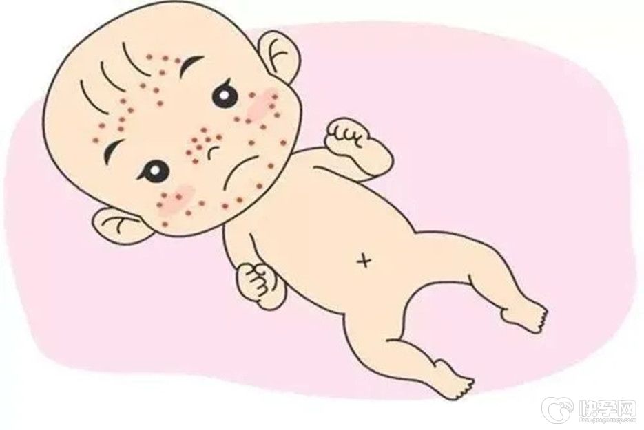 深度解析：新生儿痤疮的根源-六个护理方式事半功倍，附图片