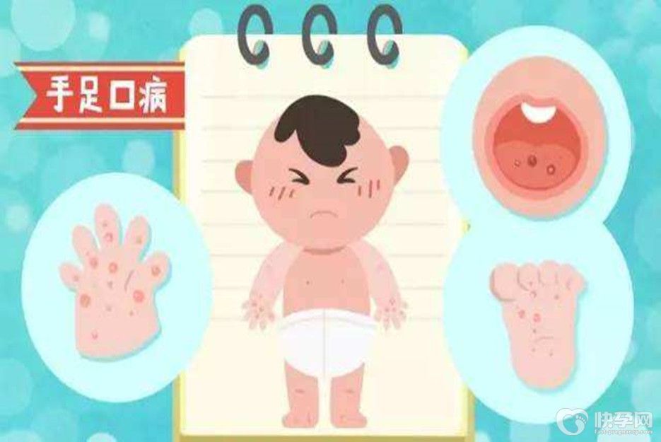 自费的手足口疫苗有必要打吗，如何预防手足口病-不强制，建议接种