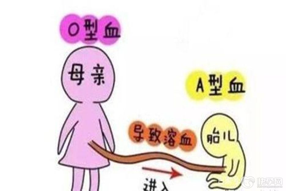 新生儿溶血性黄疸的症状，新生儿溶血性黄疸能治愈吗-带你一探究竟