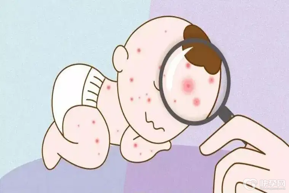 什么是儿童过敏性紫癜，这八类食物有多远离多远