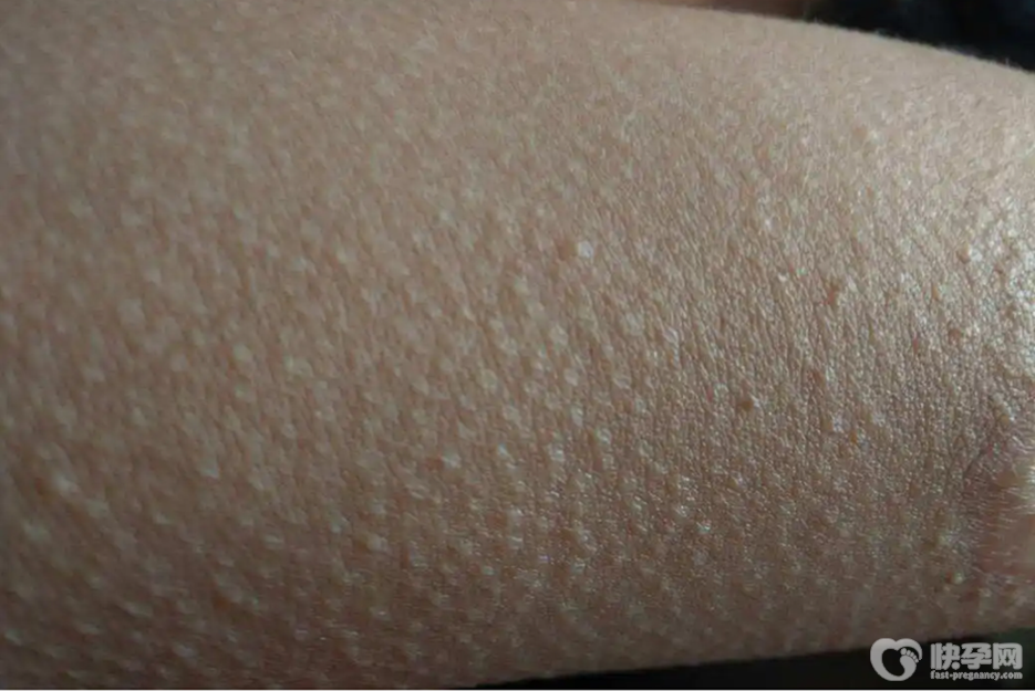 鸡皮肤是什么，孩子鸡皮肤怎么消除-仅四招帮妈妈解除烦恼