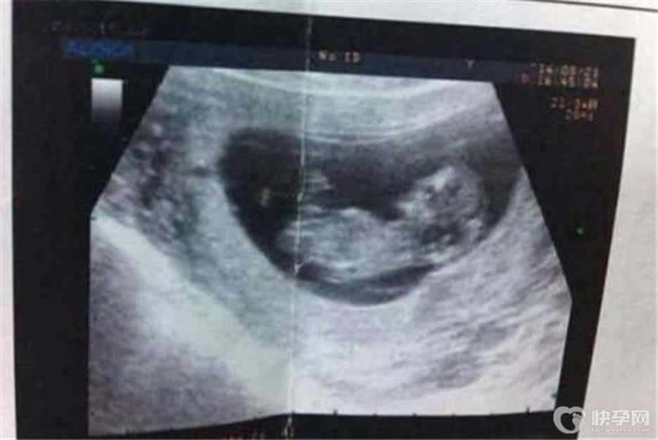 看B超立马分清男女腿部间的区别-生男生女心里有数