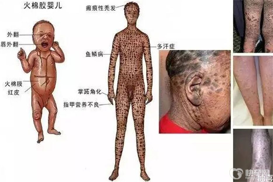 如懿传火棉胶婴儿图片分享，神似外星人的火棉胶婴儿