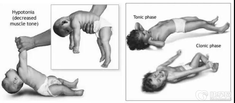 图解八个动作看宝宝脑瘫，九个早期症状快速比照判断