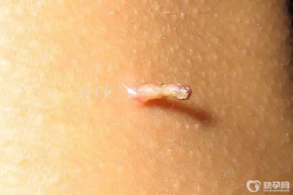 一文带你了解女性hpv初期症状图片大全，希望你一个都不占