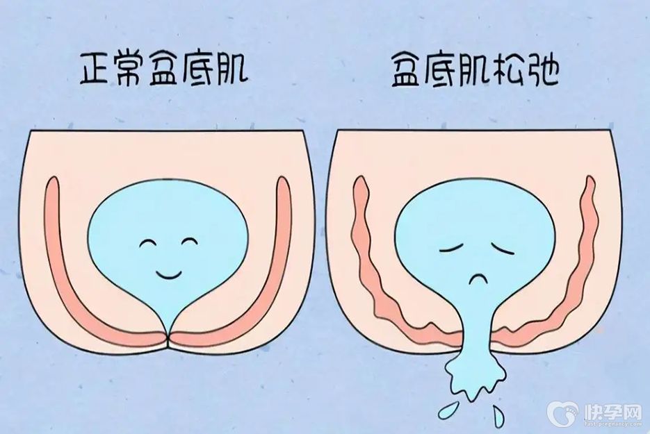 盆底肌电疗10次能修复吗？揭秘这钱花的到底值不值