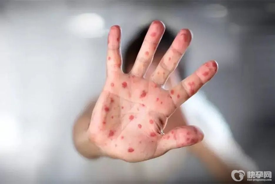 手足口病的主要传染源有哪些，家长这样做可避免宝宝中招