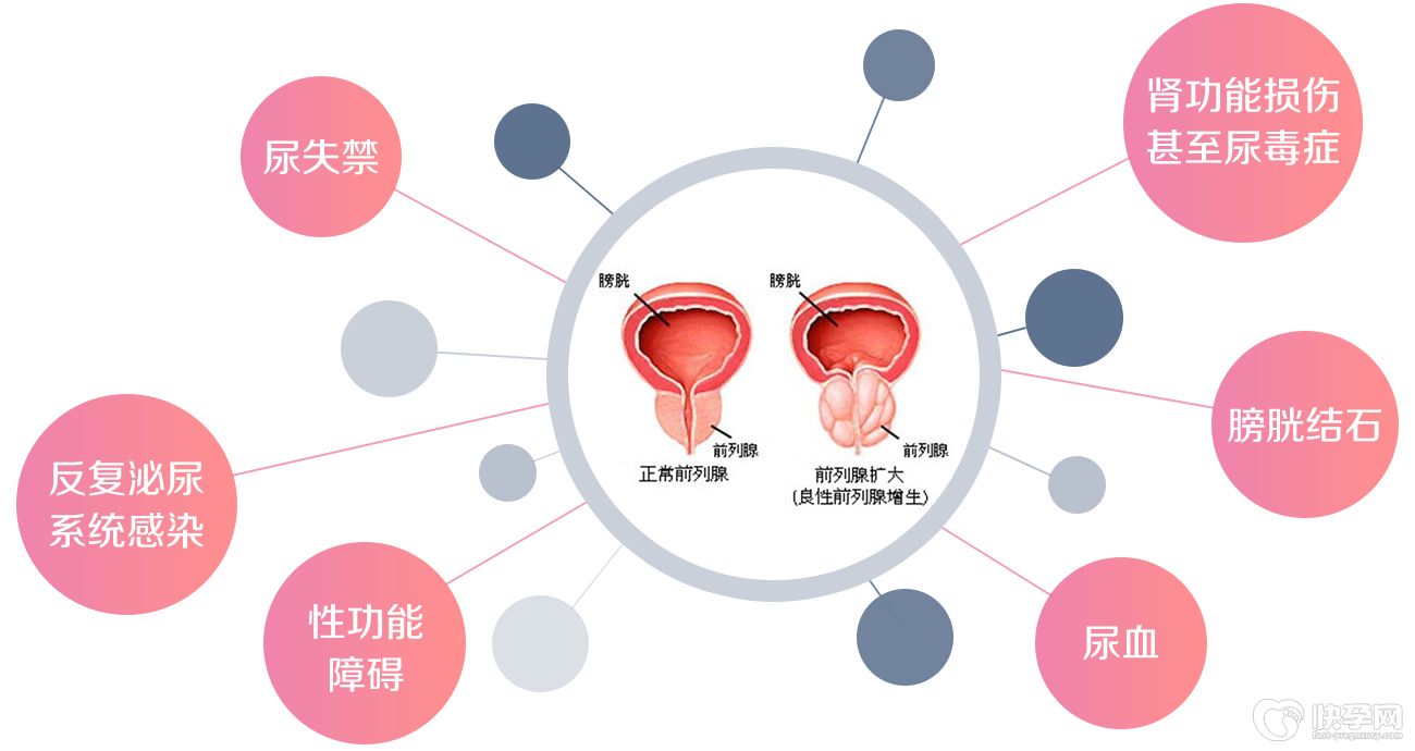 前列腺年轻人会自愈吗？做好5点非常重要