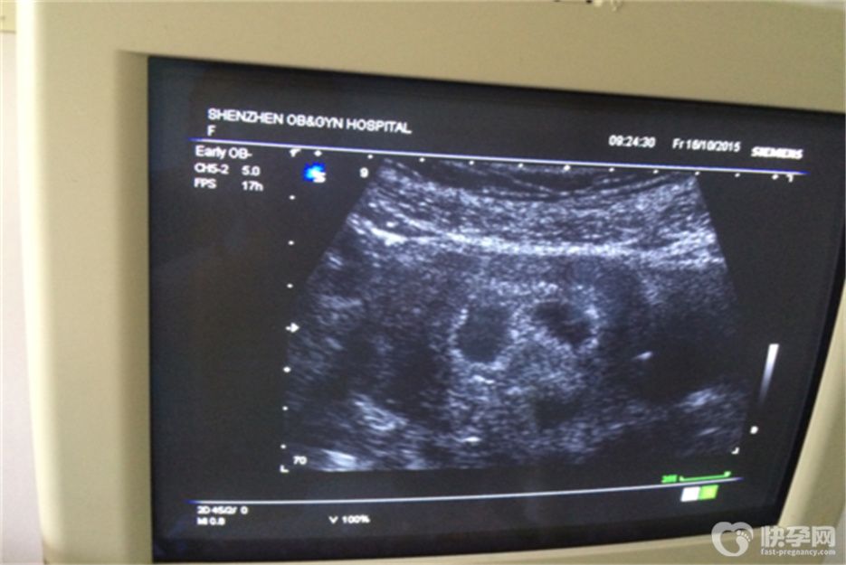 孕期四维彩超最佳时间不要错过，检查前期需要做好两个准备