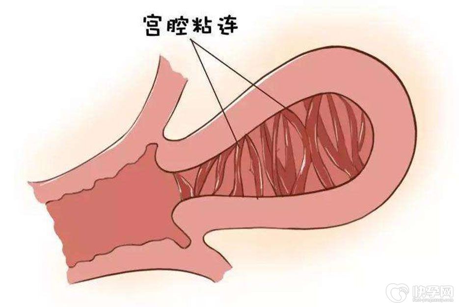 宫腔粘连能怀上孩子吗？依然有机会拥有属于自己的宝宝