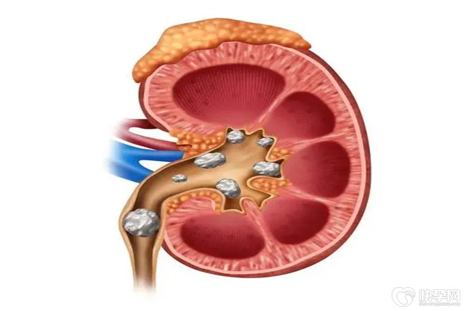 肾结石不宜吃6种水果，否则不利病情恢复