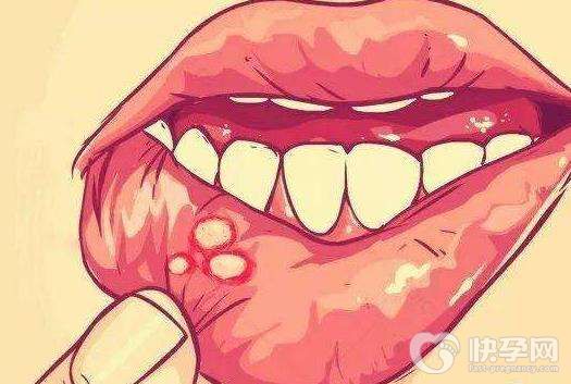 口腔溃疡吃什么水果好得快，这六种水果也许能帮到你