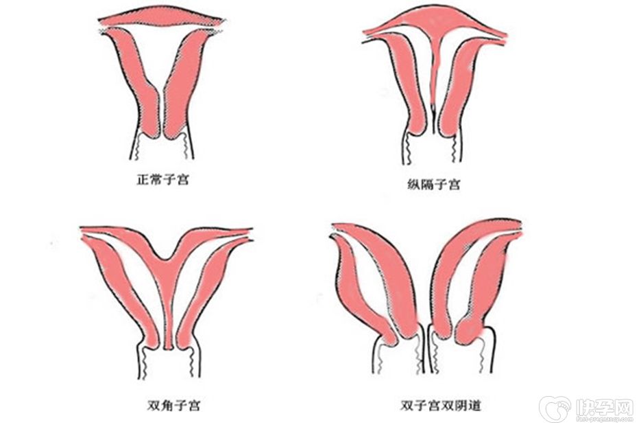 特别关注：先天双角子宫能正常生育吗47岁？能，但建议试管助孕