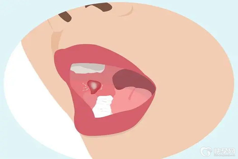 健康科普：口腔溃疡1分钟止痛，六招解决你的难忍之痛