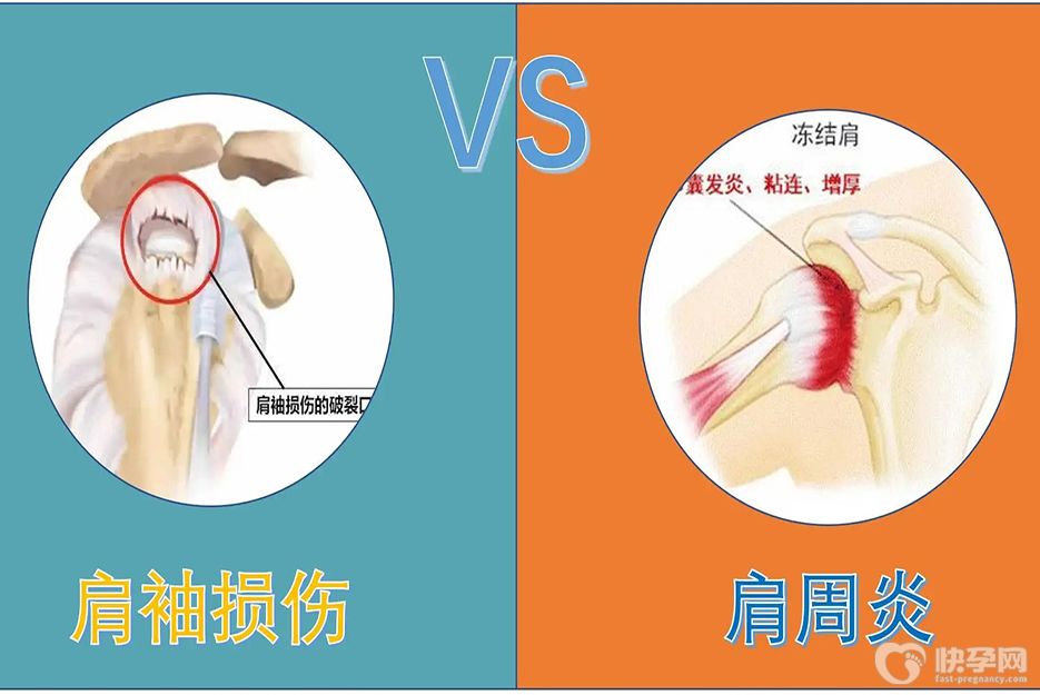 肩周炎三个动作自愈方法，摆脱胳膊抬不起来的困扰