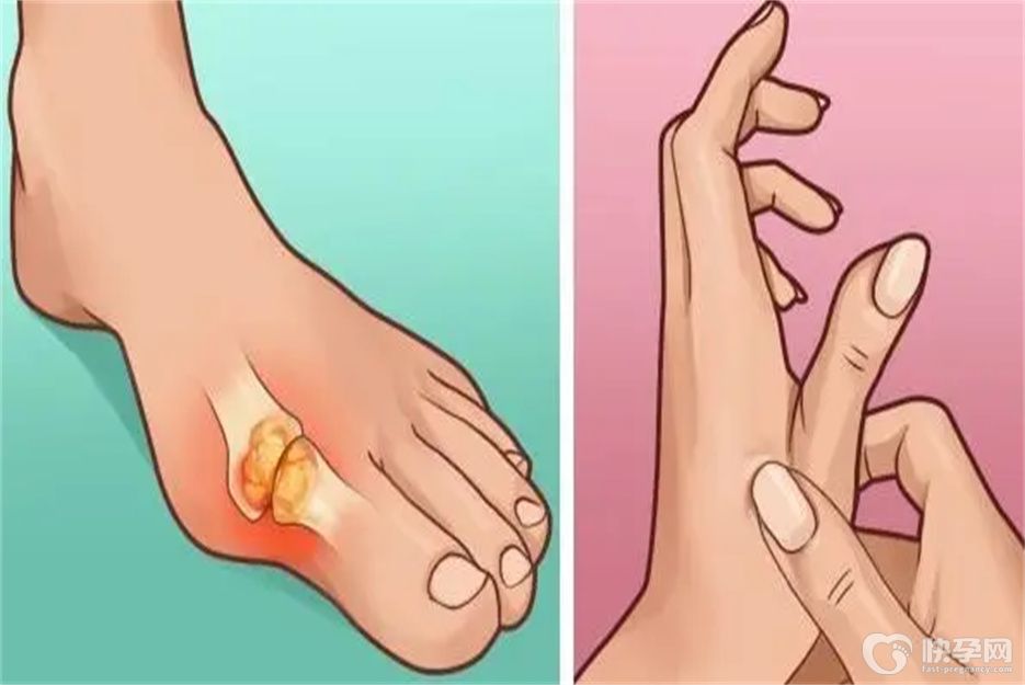 近期公开：痛风不能吃什么食物一览表，别让嘴馋害了自己