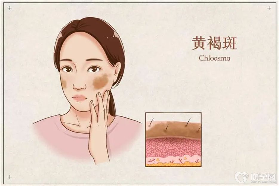 特别关注：去除黄褐斑的8个实用小妙招，用过的人都说好