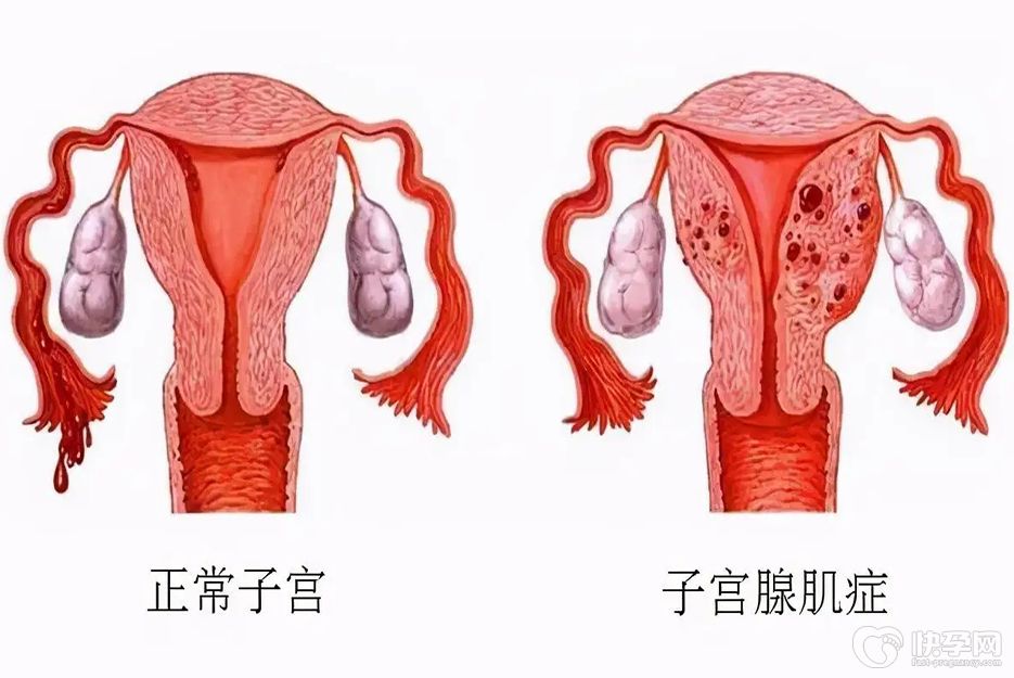 腺肌症不治会有什么后果，不仅影响怀孕还可能子宫难保