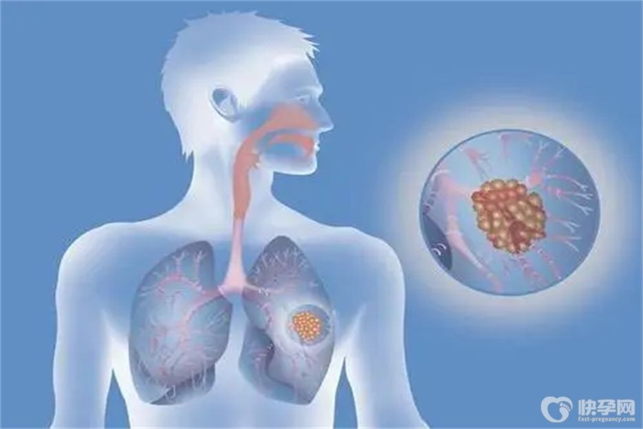 健康科普：支气管炎必吃六大食物，润肺化痰清理肺部垃圾