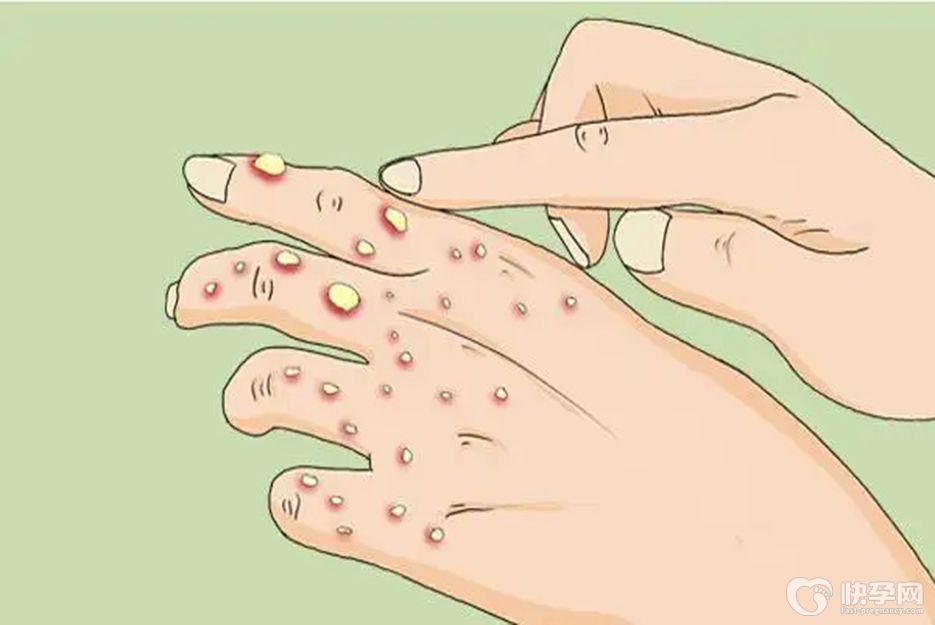 小孩手上长了像水泡一样的小痘痘，需要这两大原因及处理方法