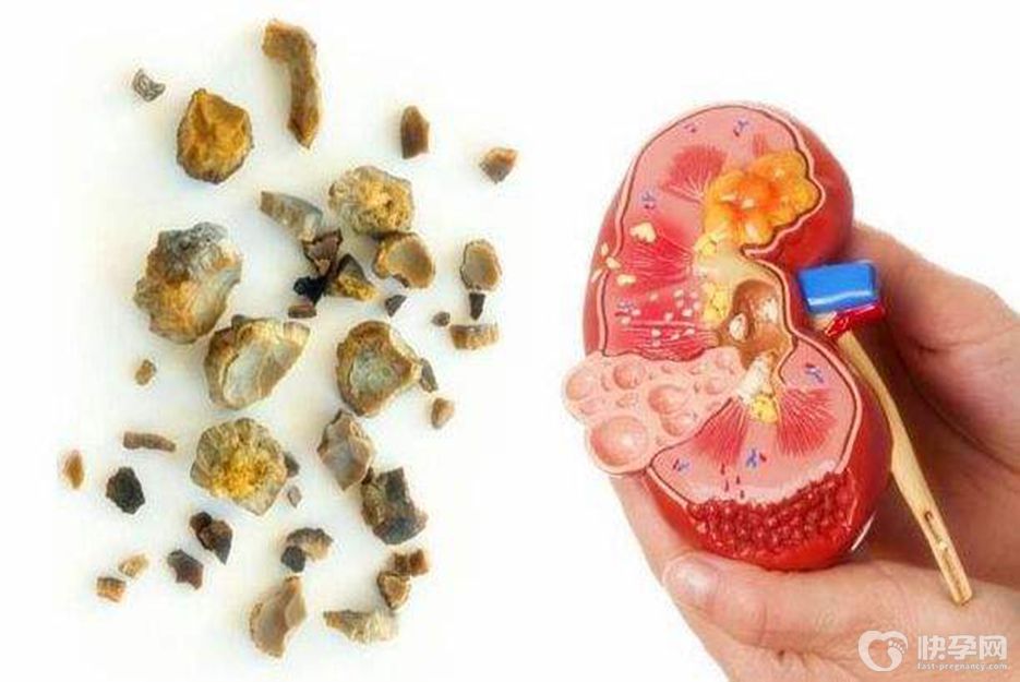 结石吃什么水果有助于排石，这八种水果不容错过