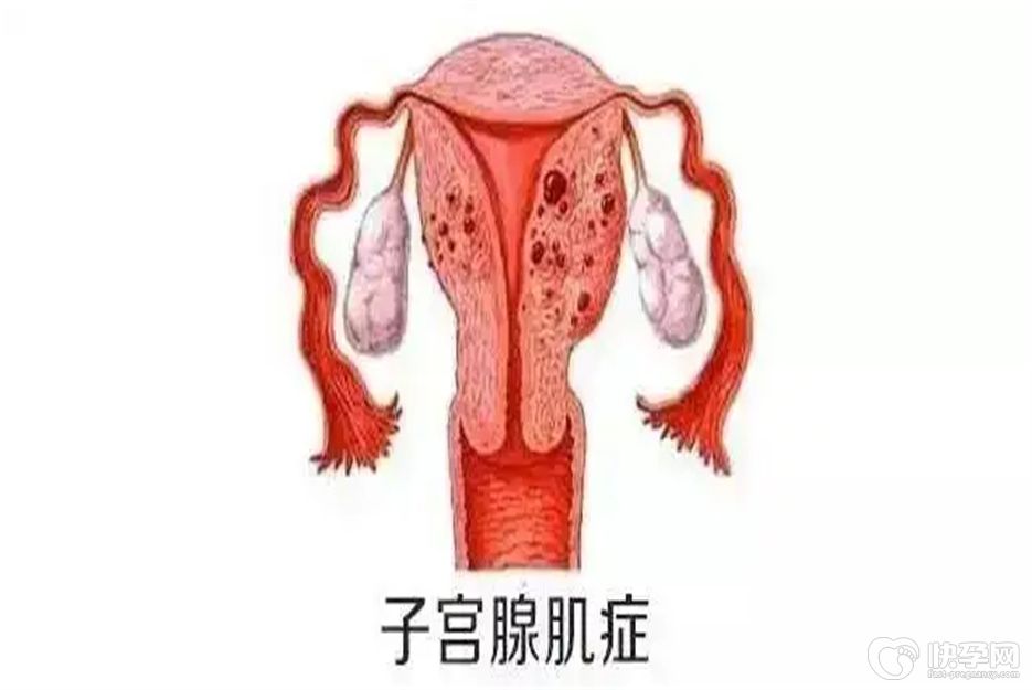 盘点腺肌症自愈的十大方法，总有一种能帮到你