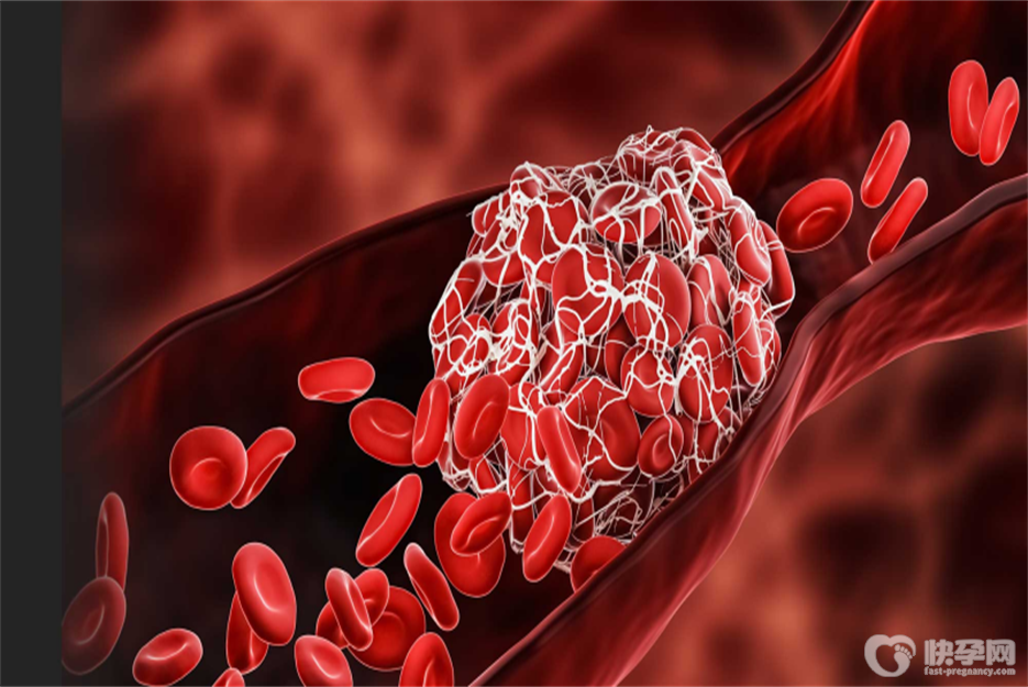 孕妇血栓的症状有哪些？身体出现这六个症状时，一定要高度警惕