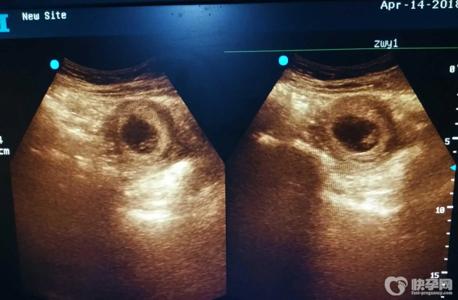 血块和孕囊哪个先排出，怎么确定孕囊掉出来了