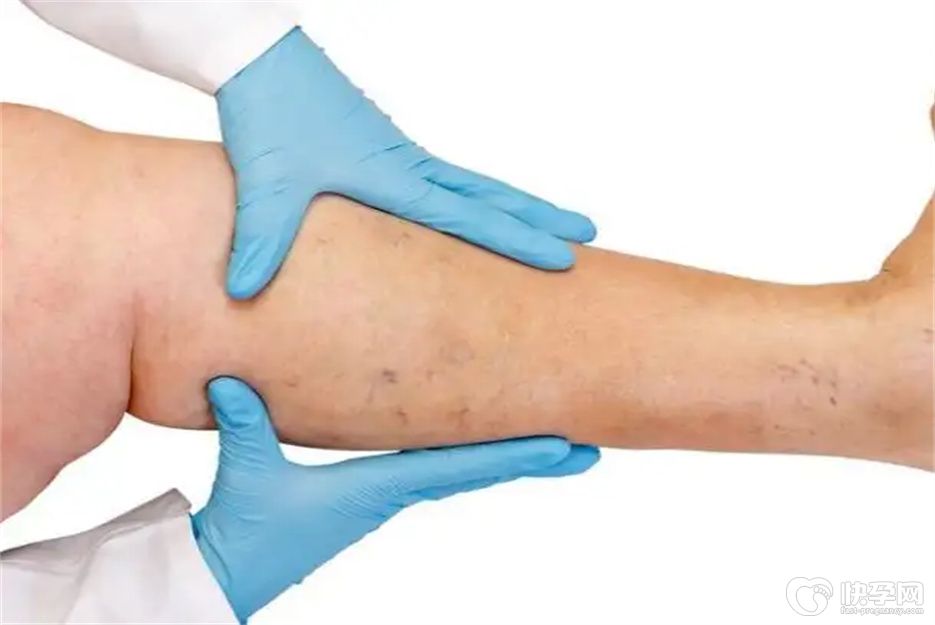 腿部血栓前兆的6个表现，可能暗示血栓正在进展