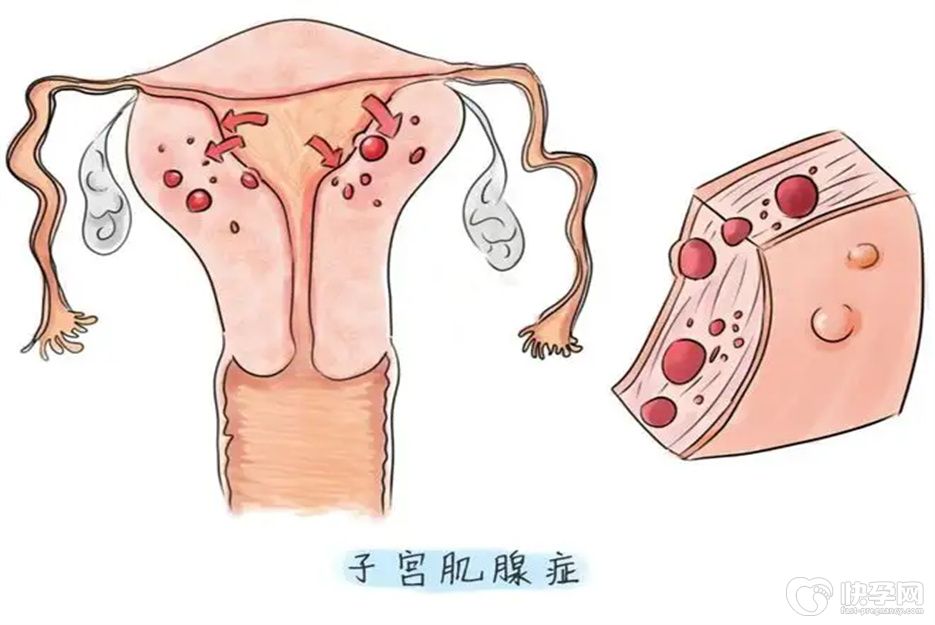 子宫腺肌症最忌讳什么？答案全在这里