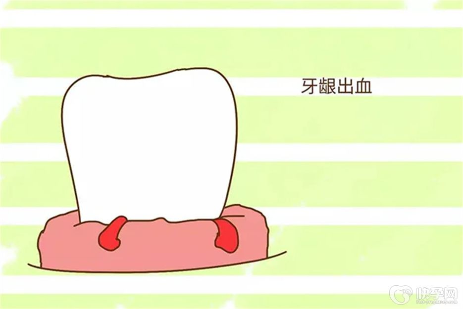 健康科普：牙龈出血止血小妙招，5招轻松帮你摆脱困扰