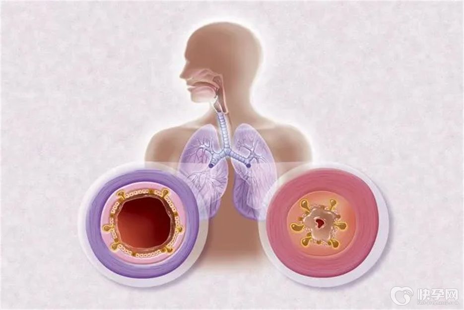跳绳可以改善支气管炎吗？答案也许和你想象的不一样